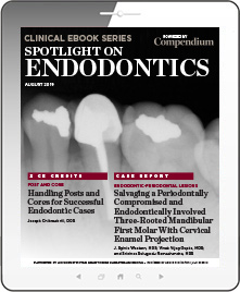 Spotlight on Endodontics Ebook Cover