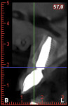 Fig 13. CBCT at 2-year follow-up.