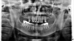 Fig 1. Pretreatment panoramic x-ray of a 60-year-old female patient who presented with periodontally condemned maxillary teeth. Her treatment plan included maxillary extractions and an immediate maxillary denture.