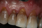 Fig 12 and Fig 13. After finishing and polishing, the OMNICHROMA material demonstrated its ability to match its surroundings, even though they ranged from light to dark in the same tooth.