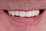 Fig 23. Final restorations, smile view.