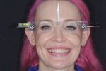 (3.) A smile design analysis was completed using facial reference glasses.