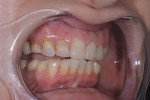 (5. THROUGH 8.) For communication with the laboratory, a complete series of preoperative photographs was acquired, including left and right lateral retracted views with the teeth apart, a frontal close-up maxillary anterior view, and a full face portrait with facial reference glasses and bite stick.