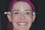 (11.) Following seating of the fi nal maxillary crowns with a neutral try-in paste, photographs were acquired with reference glasses to assess the patient’s smile line and verify her midline position.