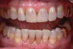 Fig 10. Pre-operative photographs of a patient who had severe tetracycline stains and wanted a brighter, whiter smile.