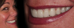 Fig 1. The patient’s original veneers at the time of delivery.
