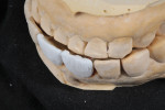 Fig 7. The exaggerated protrusive and lateral movement is checked to determine the length of the incisal edge.