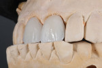 Fig 8. The author will advise the dentist to shorten No. 10 and possibly No. 7 for both esthetic and functional reasons.