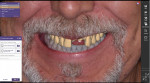 (2.) The patient’s full face portrait was overlayed over the intraoral scan in the design software.