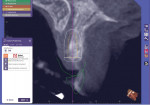 (6.) Implant planning software view of the proposed implant in the most ideal position. Note how in this position, about 25% of its body would be located in the incisive canal.