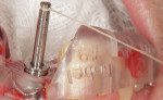 (9.) An implant was placed at site No. 9 using a fully guided surgical approach.