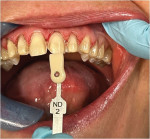 Fig 5. ND2 stump shade on teeth Nos. 7 through 10.
