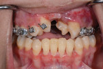 (1.) Pretreatment retracted photograph showing the results of previous orthodontic treatment and impacted canines and first premolars in the premaxillary cleft area.