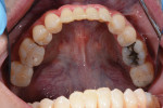 (6.) Mandibular occlusal view demonstrating an idealized arch form. The only treatment completed on the mandibular arch was placement of a bonding splint for teeth Nos. 22 through 27 using a 35% phosphoric acid etchant (Ultra-Etch™, Ultradent), universal adhesive (3M™ Scotchbond™, 3M), and flowable composite (3M™ Filtek™ Supreme Flowable Restorative [A2], 3M).