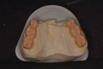 (9.) Occlusal view of the master cast with a wax-up of the survey crowns designed for the rotational path removable partial denture. A splinted design was chosen for the survey crowns to help stabilize the posterior teeth and create proper rest seats, supports, and undercuts to retain the removable partial denture while maintaining adequate contours for hygiene.