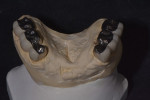 (10.) Occlusal view of the fabricated survey crowns on the master cast.