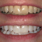 (1.) A series of before-and-after photographs showing the results of Kör Whitening treatment.