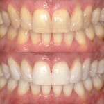 (2.) A series of before-and-after photographs showing the results of Kör Whitening treatment.