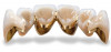 (5.) The anterior teeth must have sufficient lingual contour to allow immediate disclusion of the posterior teeth.