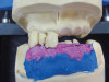 (22.) The final restorations, which reflect the changes modeled through the provisional phase.
