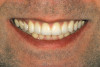 (4.) Exaggerated “E” photo. In this photo, the incisal edges should lie between 50% to 70% from the upper lip to the lower lip.