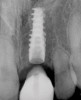 (15.) Preoperative maxillary, occlusal view.