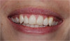 (42.) Postoperative mandibular occlusal view. Note the composite tops on teeth Nos. 28 through 31.