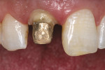 Figure 3  Preoperative view of the crown preparation for tooth No. 8. Note the medium texture on tooth No. 9.