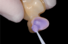 Provisional prosthesis guide is used as a surgical guide to verify adequate bone reduction and leveling with the incisal and occlusal planes of the prosthesis.
