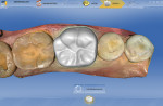 Figure 9 The restoration proposed by CEREC SW 4.0.