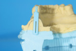 Figure 11 Tissue depths are measured in the CBCT software, transferred to the cast, and the remainder of the mandibular body is drawn in. The Bucco Lingual Positioner (BLP) is placed at the desired buccolingual position for the implant, but also at the de