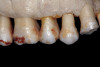 Fig 7. Dry the tooth surface with compressed air that is free of oil and moisture for a minimum of 10 seconds.