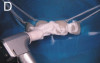 Figure 4 The wax try-in is a critical step for the design of esthetic and functional determination for the final restorations and allows for patient input before final completion.