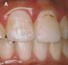 Figure 8 The high smile with the significant loss of papilla and “black triangle” presented a clinical dental and a psychological problem for the patient.