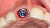 Figure 15 Defects were treated with a combination of a mineral collagen bone substitute combined with an enamel matrix derivative.