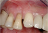 Figure 18 The 10-year clinical evaluation revealed periodontal health at the regenerated site with minimal periodontal probing depth.