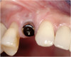 Figure 19 This patient presented with esthetic and functional concerns, but was reluctant to proceed with reconstructive dental treatment.