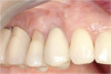 Figure 22 The final preparations were completed after pre-prosthetic periodontal treatment, and dental implant surgery was accomplished.
