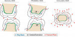 Figure 7  Shear fracture planes from occlusal forces.