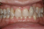 Figure 3  Pretreatment image of the patient’s teeth in maximum intercuspation.