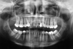 Figure 5  Pre-treatment panoramic radiograph. Note the generalized horizontal bone loss, missing maxillary right canine, and infraerupted maxillary left canine.