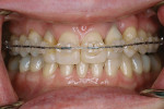 Figure 8  Frontal image of the patient in latter stages of orthodontic therapy. Note that the reverse articulation has been corrected.