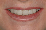 Figure 14  Posttreatment image of the patient’s close-up smile.