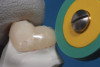 Fig 6. Anterior crowns fabricated from monolithic 4Y zirconia, which was chosen because of its desired balance of strength and translucency.