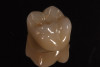 Fig 13. Tooth preparations showing dark discoloration
