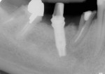 Figure 2  Radiograph of tooth No. 29 demonstrating a fractured crown.
