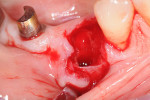 Figure 3  Tooth No. 29 extracted; note loss of buccal wall.