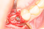 Figure 9: Occlusal view of a fully submerged implant surrounded by healthy bone.