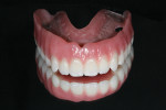 Figure 11 Processed maxillary bar-retained overdenture.