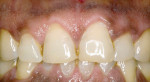 Figure 11 Case 3's 6-month post-treatment view. Patient now desires treatment for other teeth.